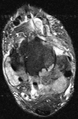 Figure 2 for case Gout arthritis ( RID3567 )